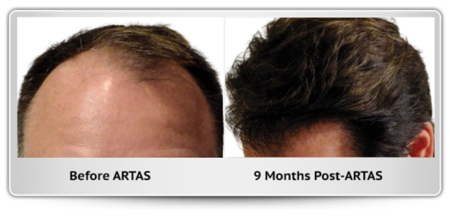 Before and After Images – Hair Transplant Austin Texas