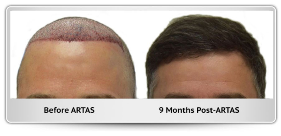 Before and After Images – Hair Transplant Austin Texas